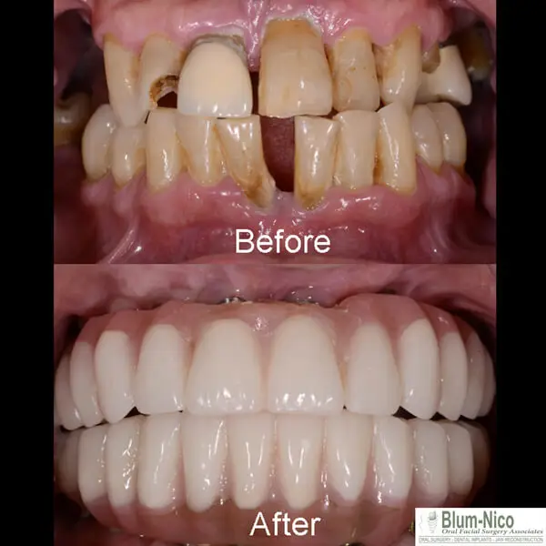 Miami Beach oral surgery