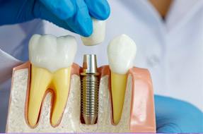Miami beach dental implants
