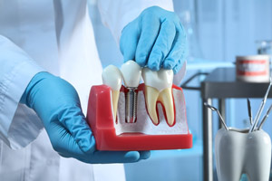 The Science Behind Dental Implants