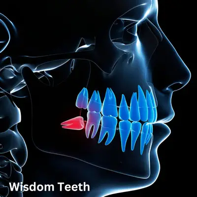 Miami Beach wisdom teeth